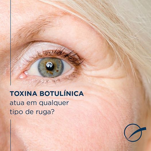 A Toxina Botulínica atua em qualquer tipo de ruga?